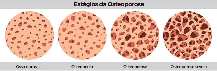 Osteoporose: a perda progressiva de massa óssea