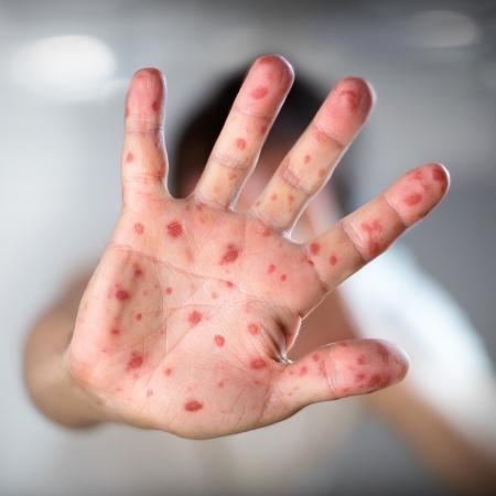 Campanha de vacinação contra o sarampo é prorrogada até 31 de outubro
