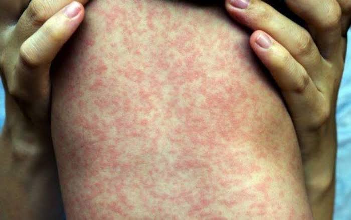 Friburgo confirma 2 primeiros casos de sarampo e tem outros 10 suspeitos