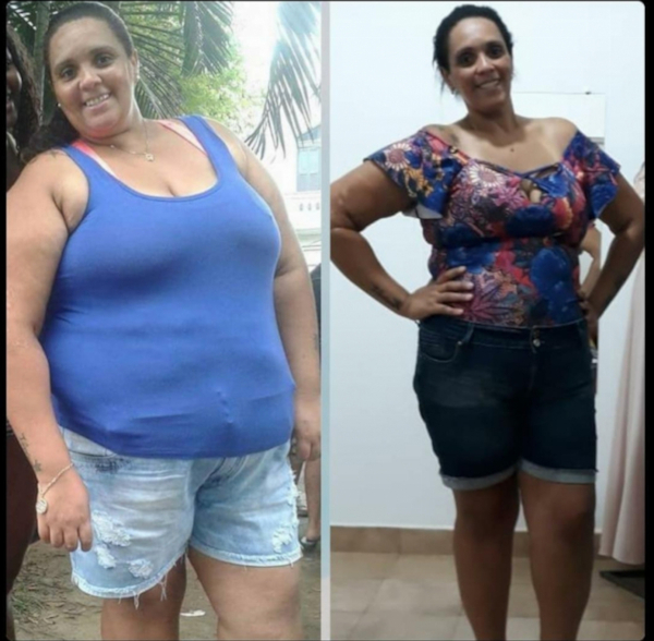 Vivian Aparecida antes e depois da cirurgia (Arquivo pessoal)